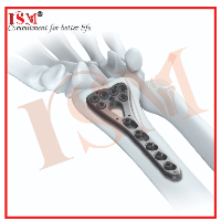 2.7mm Locking System