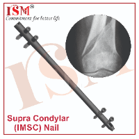 Supra Condylar (IMSC) Nail