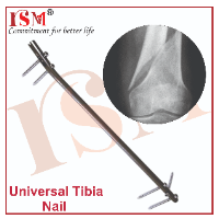Universal Tibia Nail 